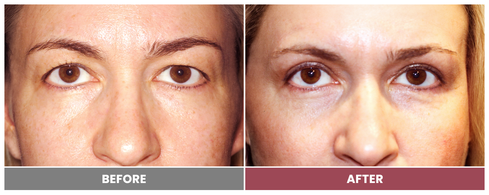 Upper Blepharoplasty - Case 35